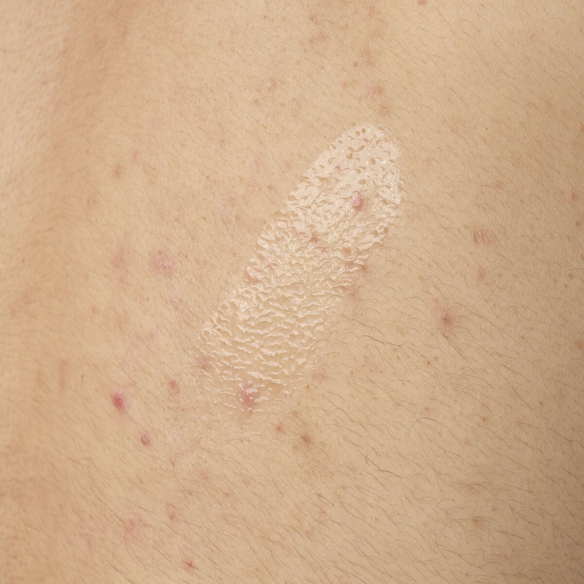 salicylic-acid-0-5-body-serum-q3 ORD-salicylic-acid-05-body-240ml-application.jpg