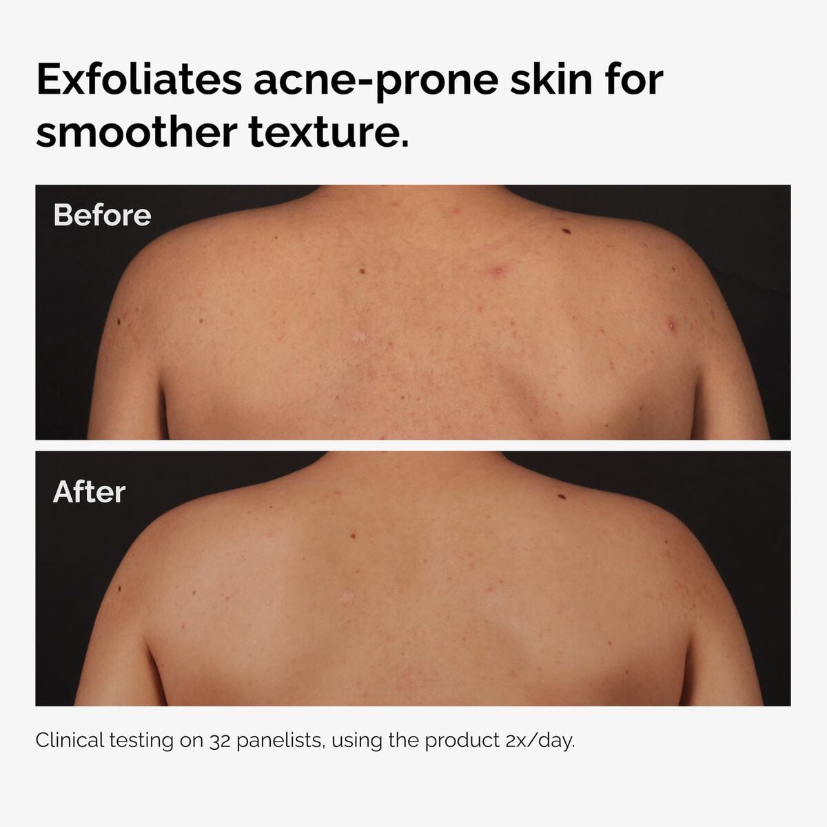 salicylic-acid-0-5-body-serum-q3 ord-salicylic-acid-body-serum-before-after-graphic-NA.jpg