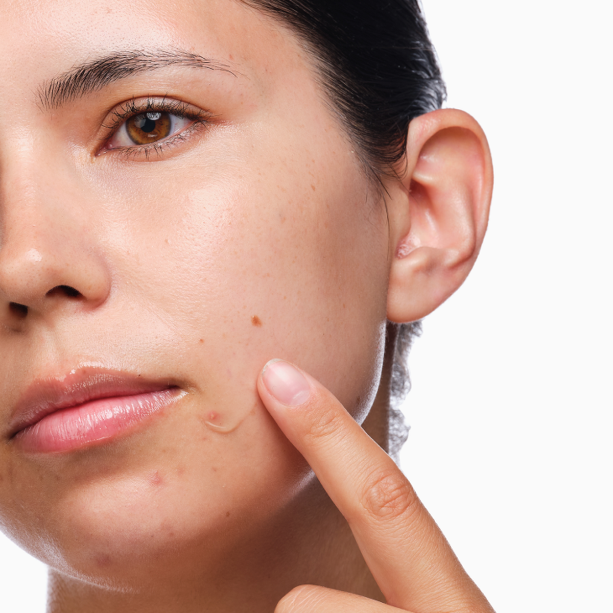the-acne-set-a6 rdn-the-acne-set-application.png